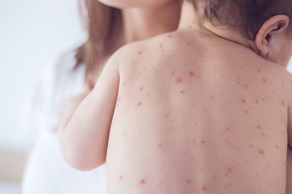 triệu chứng sốt xuất huyết ở trẻ em 1