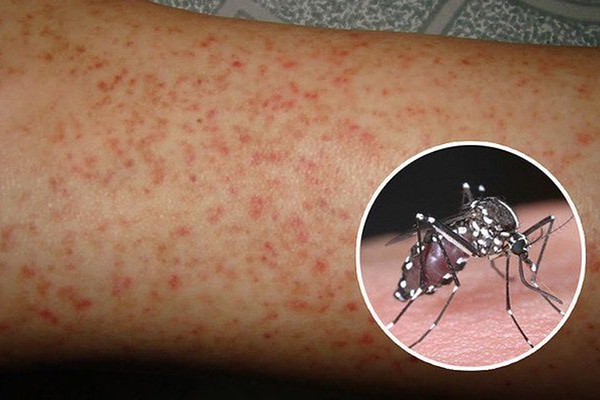 Phát ban là một trong các triệu chứng sốt xuất huyết ở người lớn