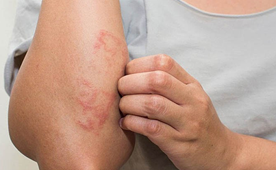 Viêm da cơ địa là gì? Triệu chứng, nguyên nhân, biến chứng, phòng ngừa -  Bệnh viện quận 11