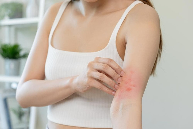 Cách kiểm soát bệnh chàm và giảm ngứa hiệu quả cho người lớn