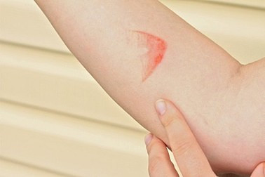 Bỏng và các cấp độ của bỏng: Từ nhẹ nhất cho tới nghiêm trọng nhất